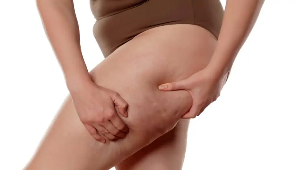 A woman holding the skin of her 29 inch thighs