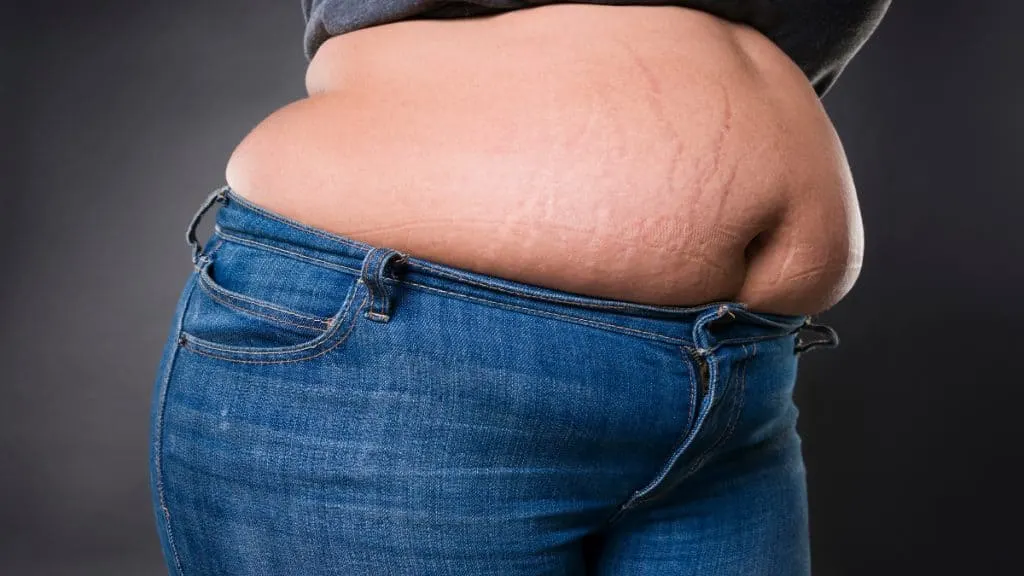 Close up of an obese woman's 50 inch waist