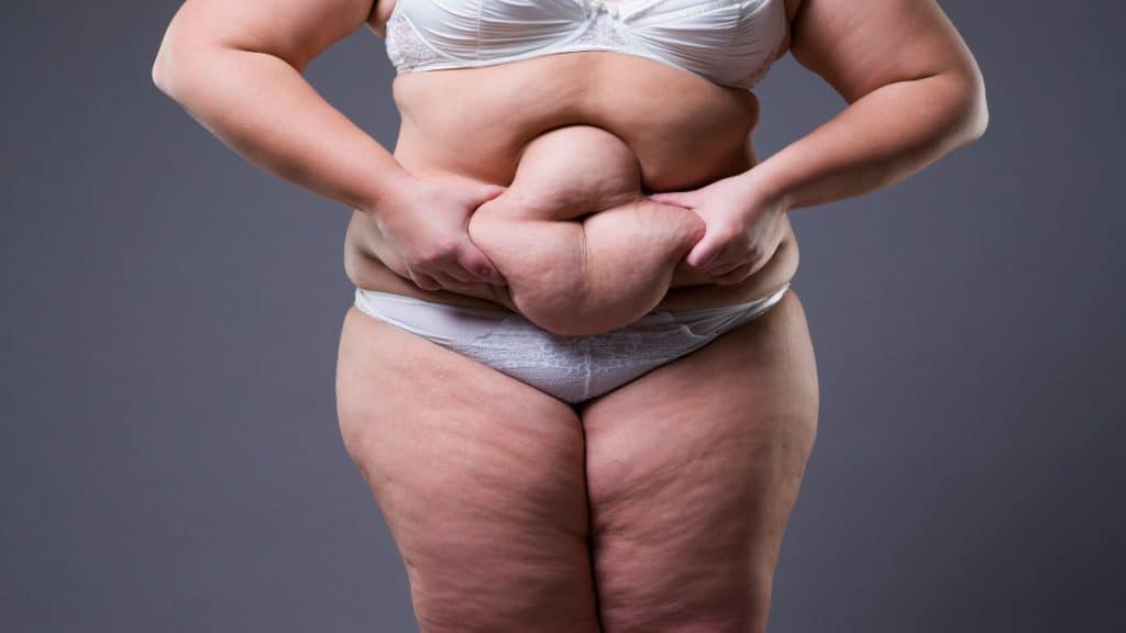 An obese woman grabbing the fat on her 53 inch waist