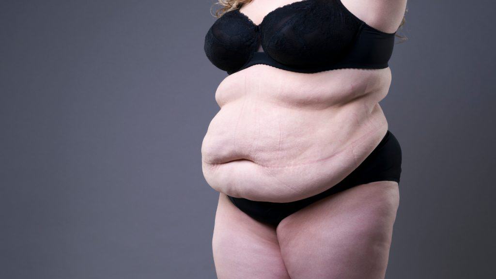 An obese woman with a big 70 inch waist