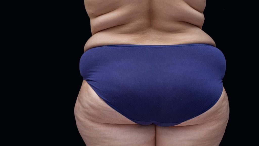 An obese woman with 20 inch wide hips