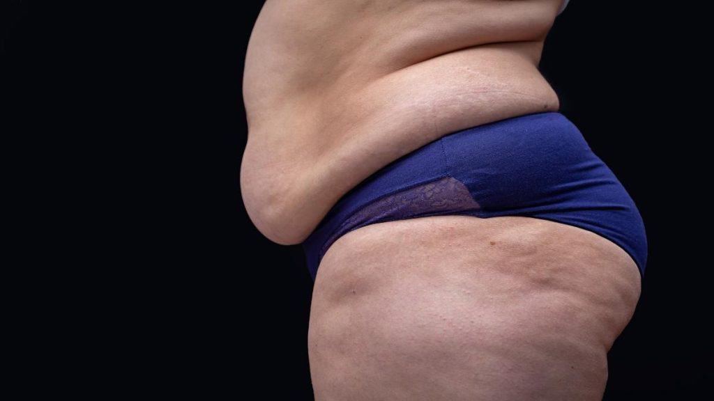 An obese woman with 24 inch wide hips