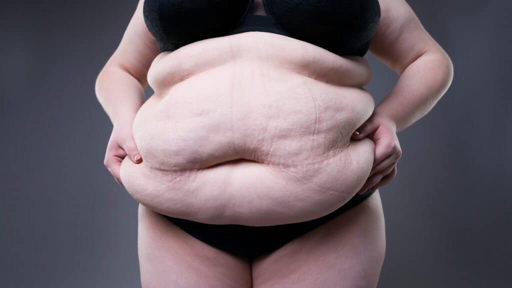 A 100 BMI woman showing her belly