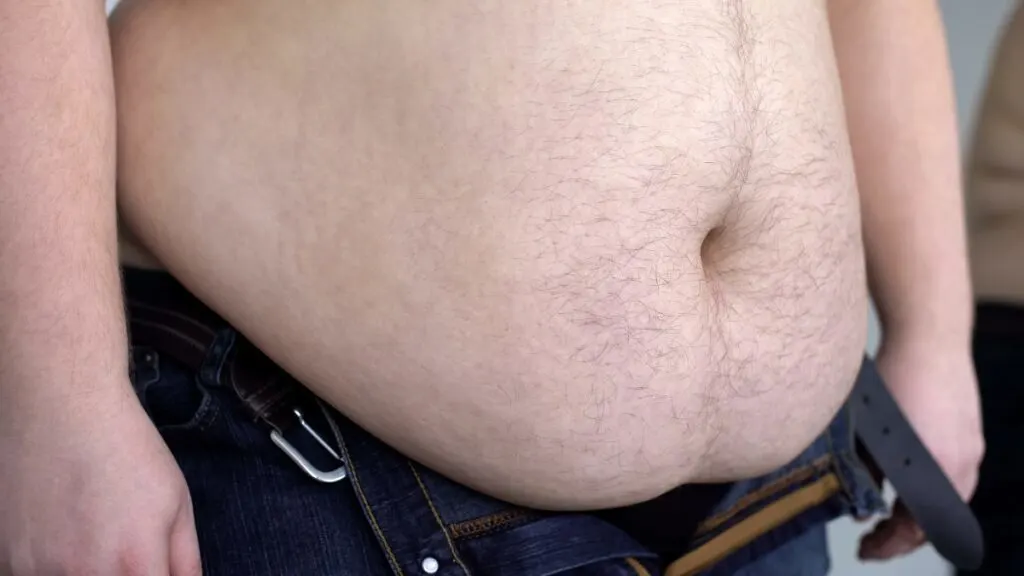 The stomach of a BMI 58 man