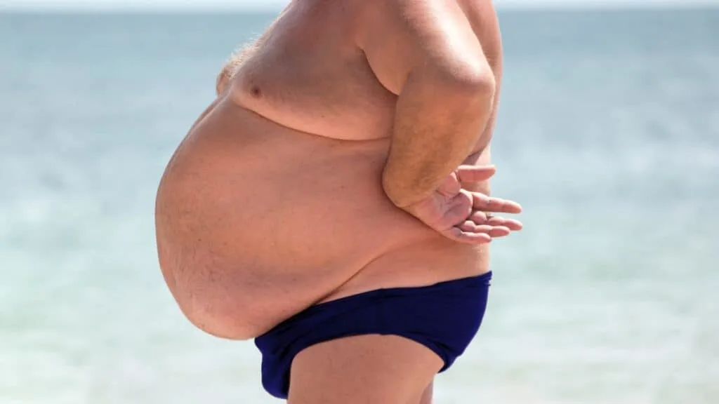 An obese man with a BMI of 56